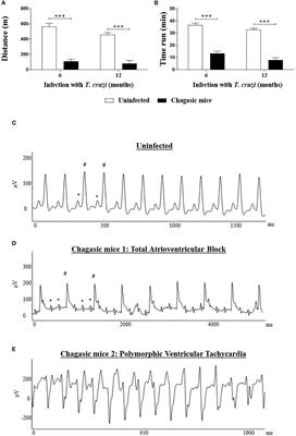 The effects of inflammation on connexin 43 in chronic Chagas disease cardiomyopathy